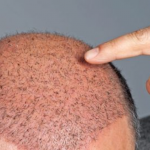 Методы пересадки волос: Эффективные решения для восстановления густоты волос